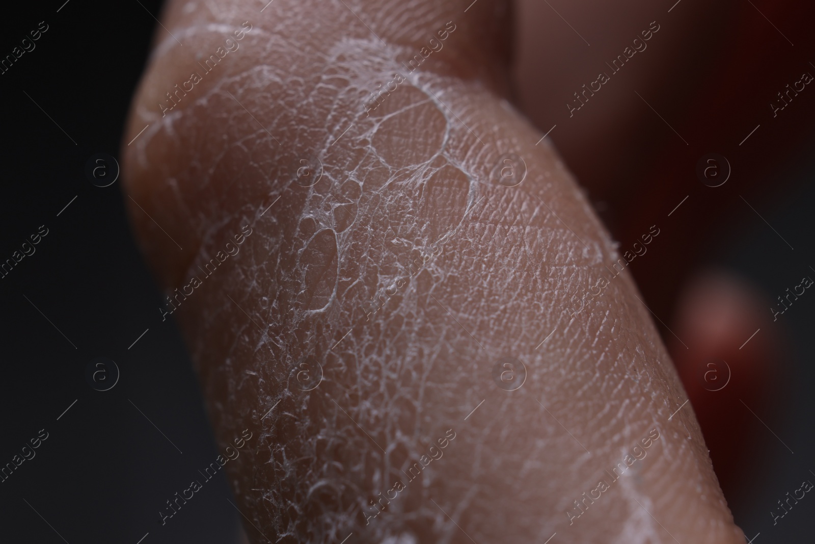 Photo of Woman with dry skin on hand, macro view