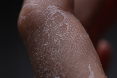 Photo of Woman with dry skin on hand, macro view