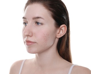 Photo of Young woman with acne problem on white background