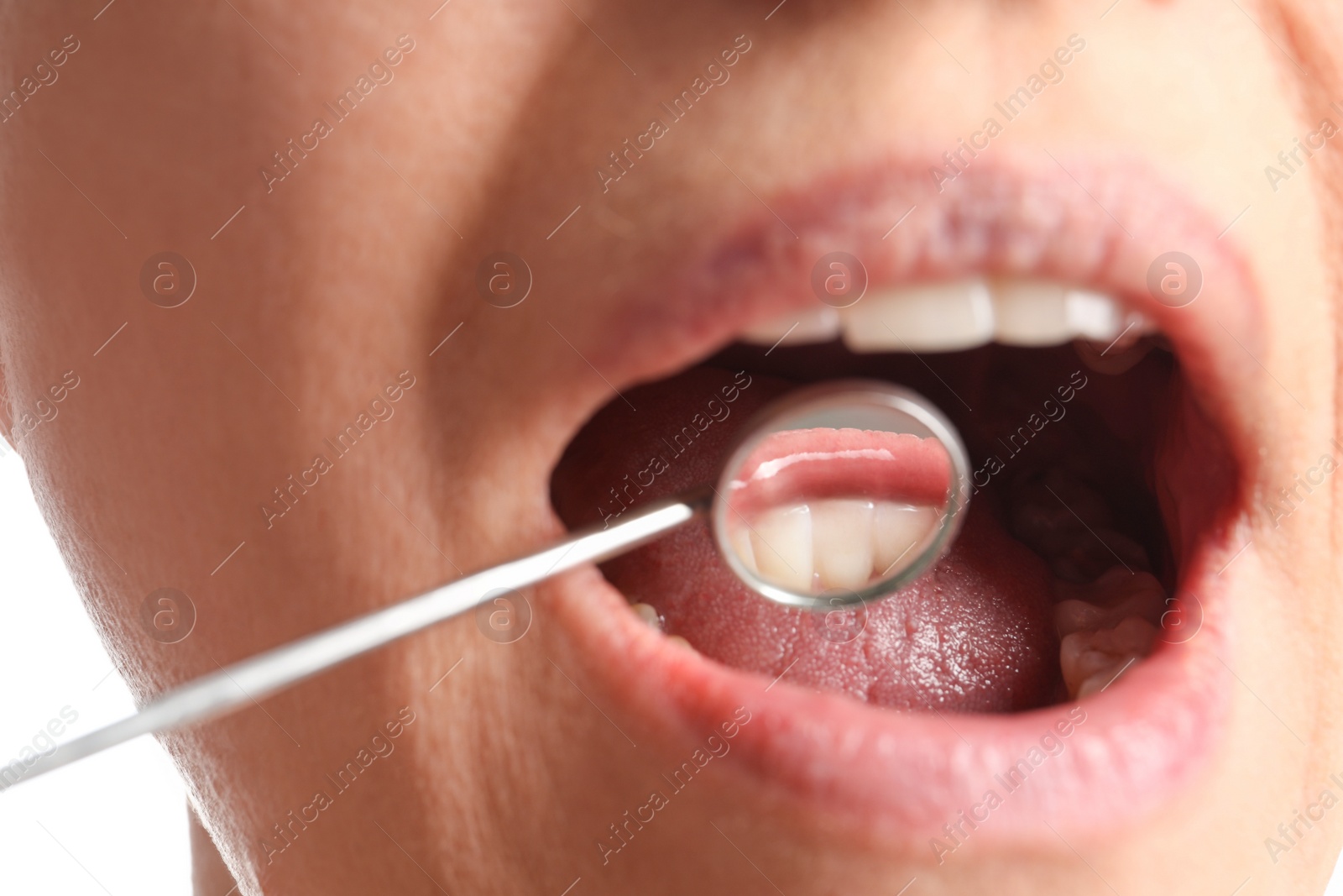 Photo of Examining patient's gums on white background, closeup view