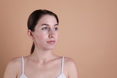 Young woman with acne problem on beige background. Space for text