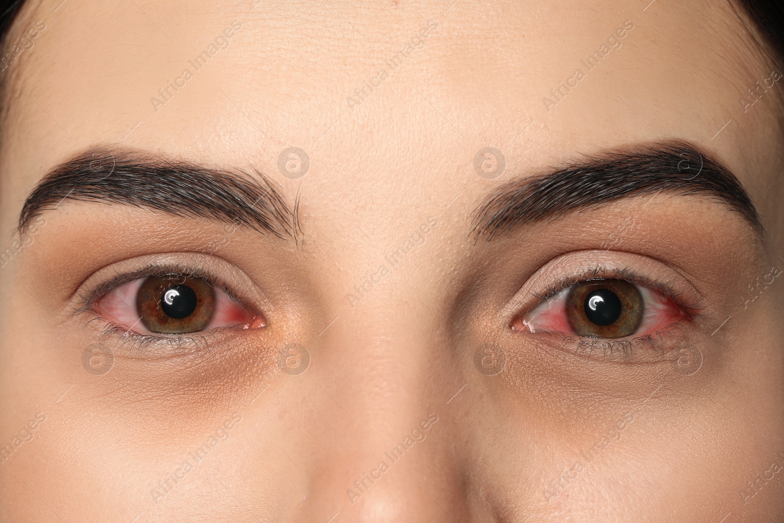 Image of Woman with red eyes suffering from conjunctivitis, closeup