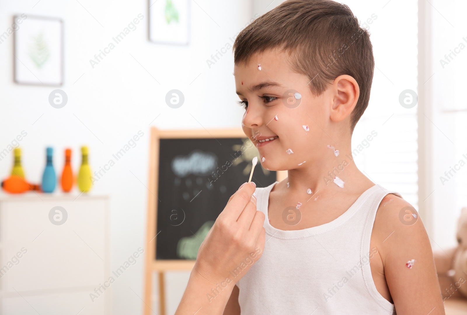 Photo of Woman applying cream onto skin of little boy with chickenpox at home