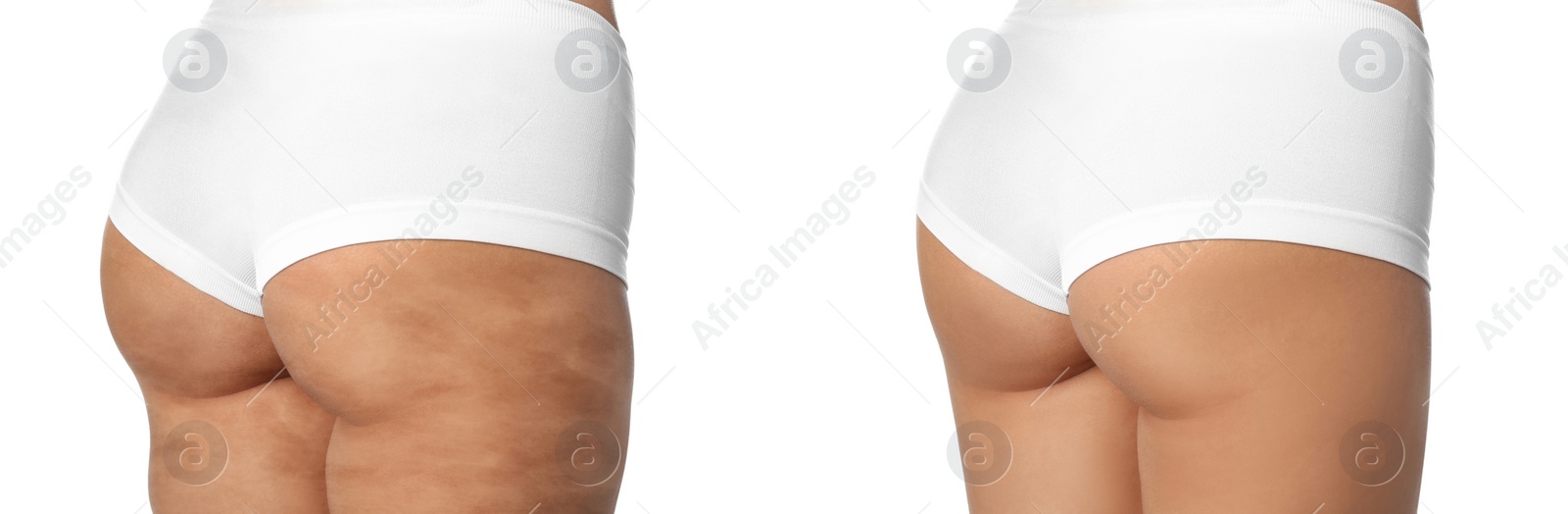 Image of Young woman before and after beauty procedure on white background, closeup. Banner design