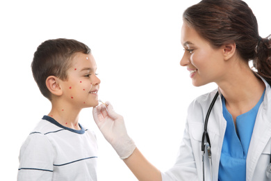 Doctor applying cream onto skin of little boy with chickenpox on white background. Varicella zoster virus