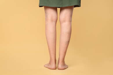 Closeup view of woman with varicose veins on yellow background