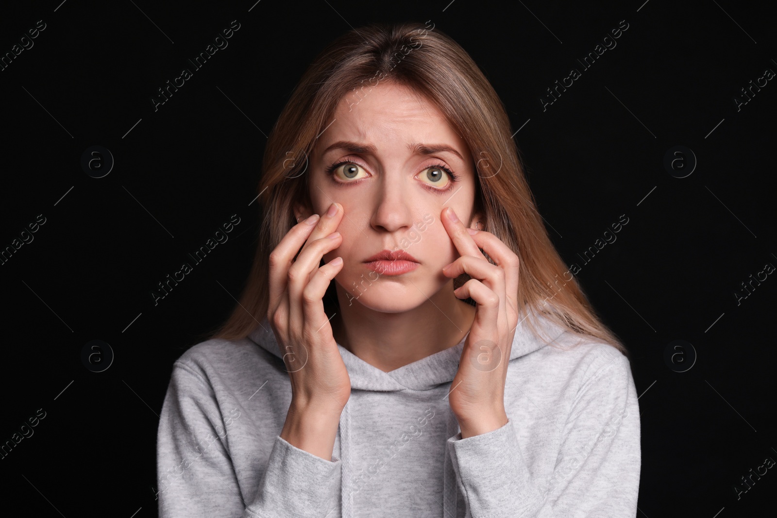 Photo of Woman checking her health condition on black background. Yellow eyes as symptom of problems with liver