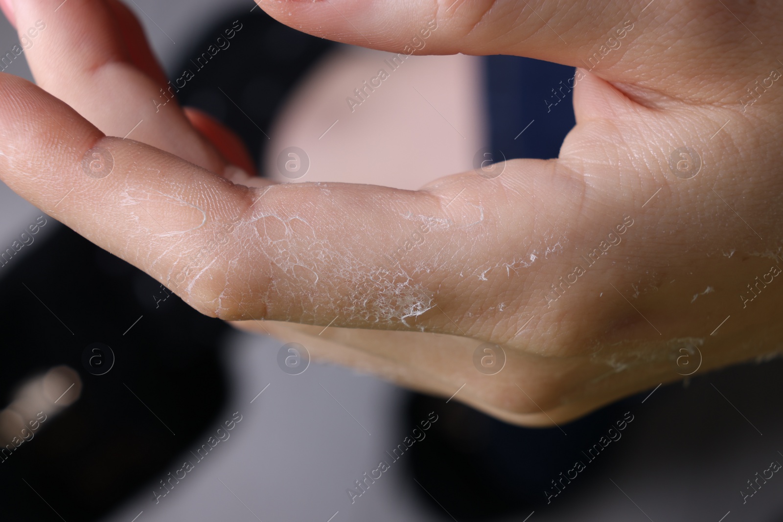 Photo of Woman with dry skin on hand against blurred background, macro view