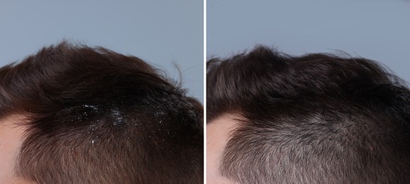 Man showing hair before and after dandruff treatment on grey background, collage