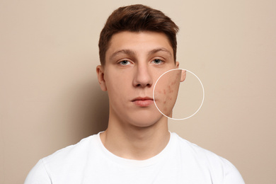 Image of Teenage boy with acne problem on beige background