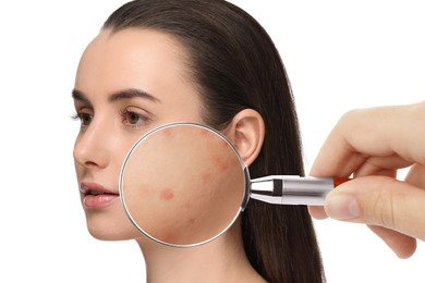 Dermatologist looking at woman's face with magnifying glass on white background, closeup. Zoomed view on acne