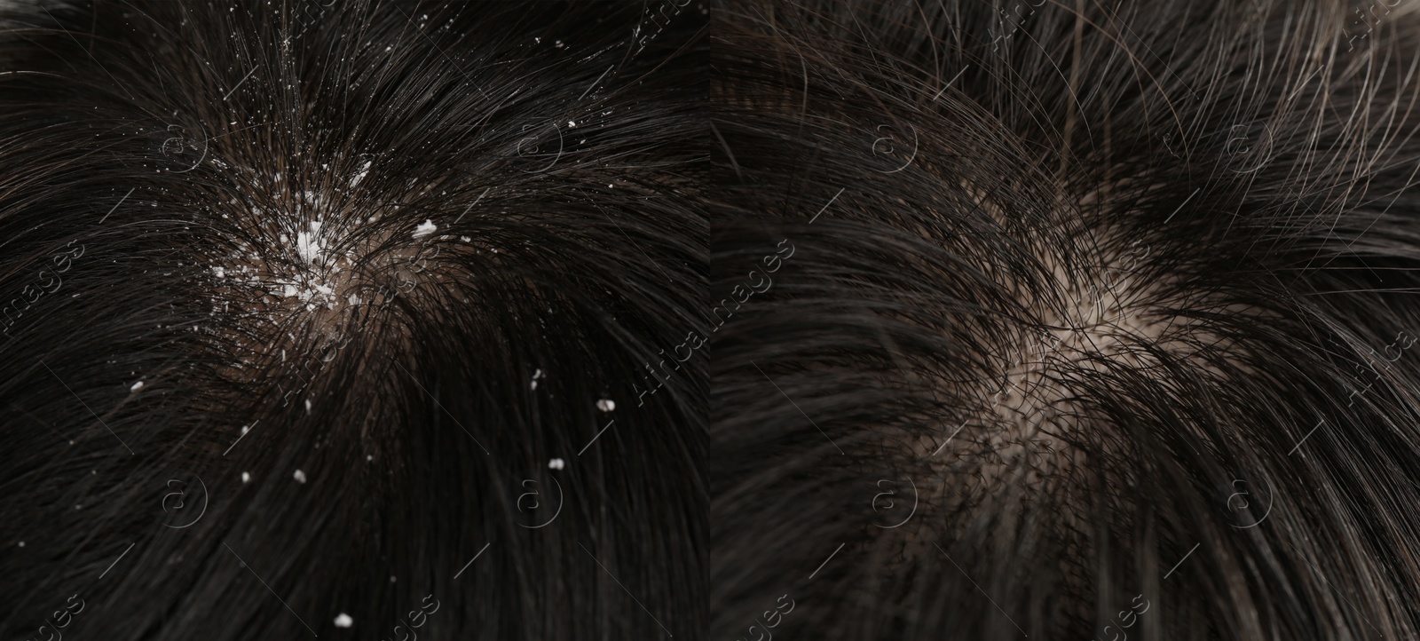 Image of Woman showing hair before and after dandruff treatment, collage