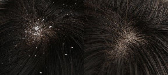 Woman showing hair before and after dandruff treatment, collage