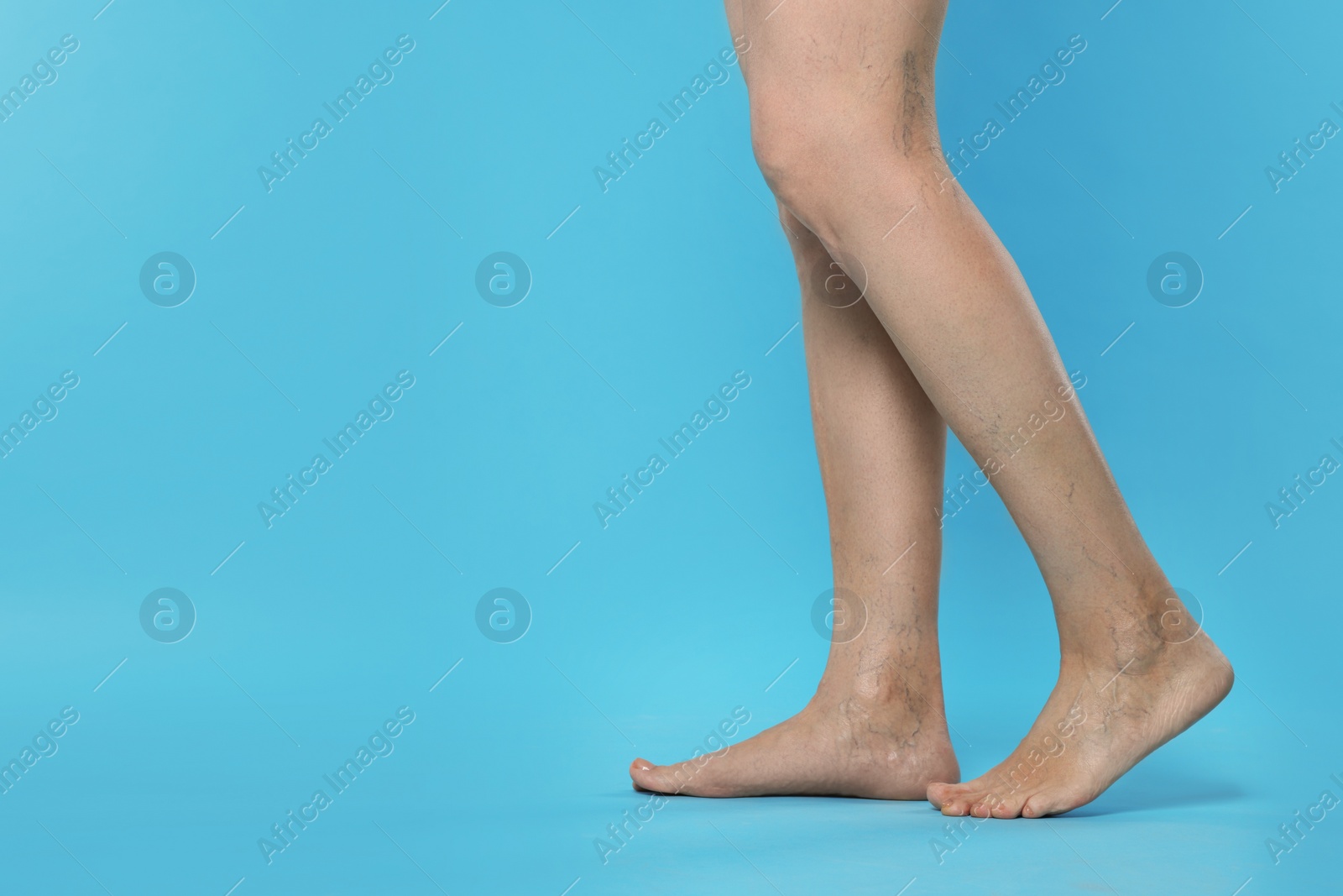 Photo of Closeup view of woman with varicose veins on light blue background. Space for text