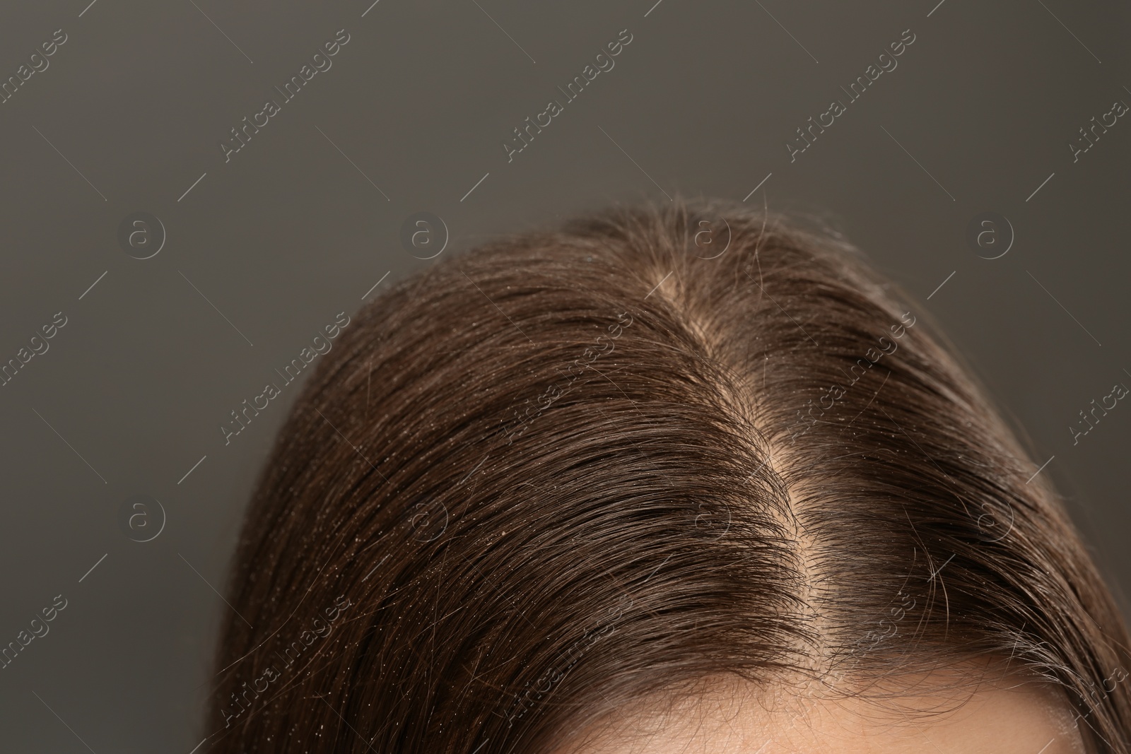 Photo of Woman with dandruff in her dark hair on grey background, closeup