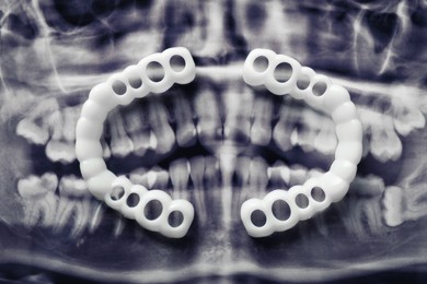 Photo of Mouth guards on dental scan, flat lay. Bite correction