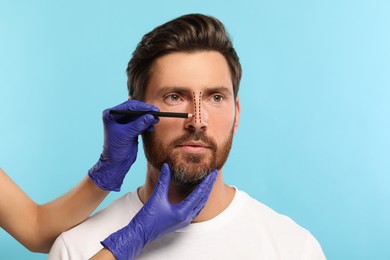 Man preparing for cosmetic surgery, light blue background. Doctor drawing markings on his face, closeup