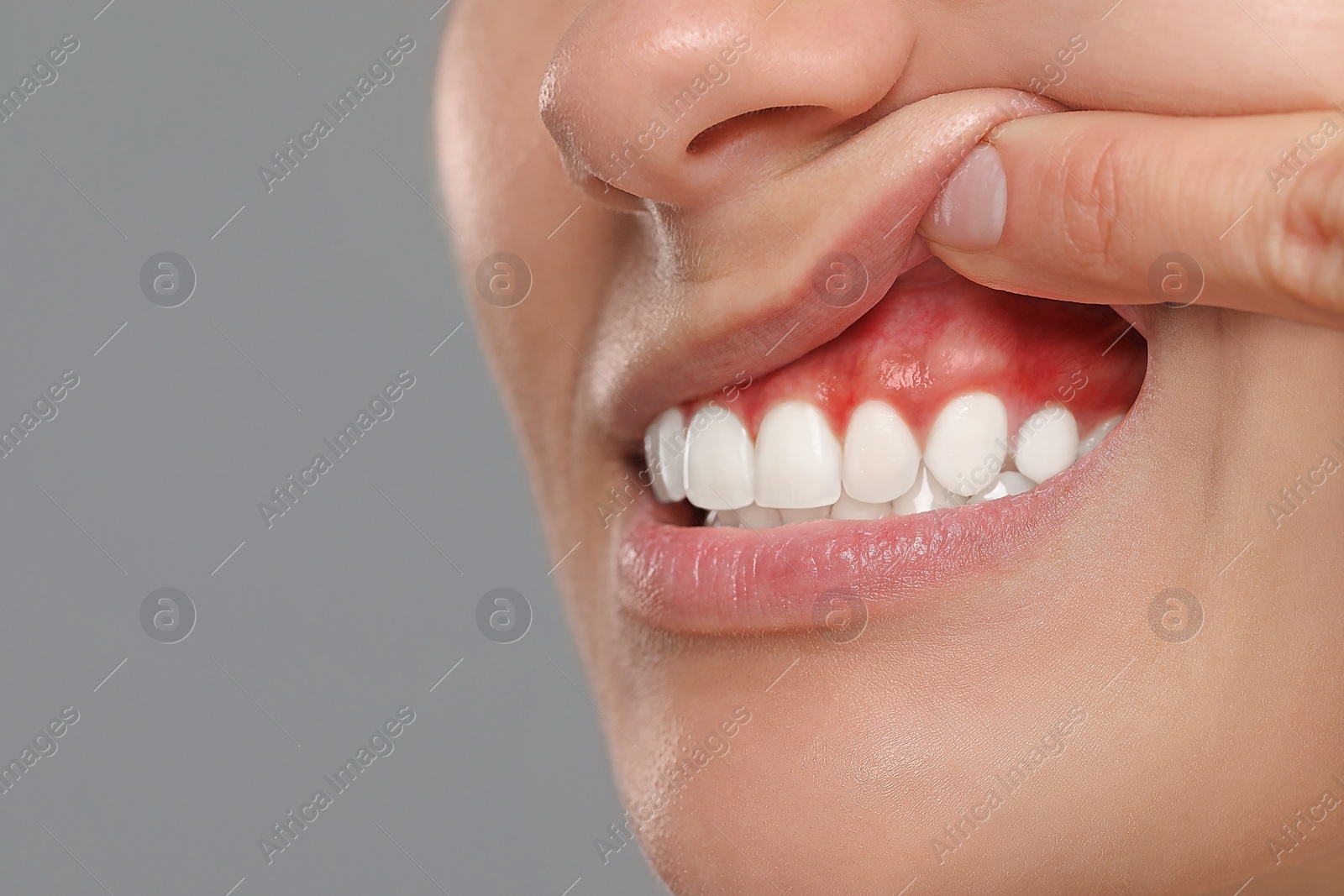 Image of Woman showing inflamed gum on grey background, closeup. Space for text