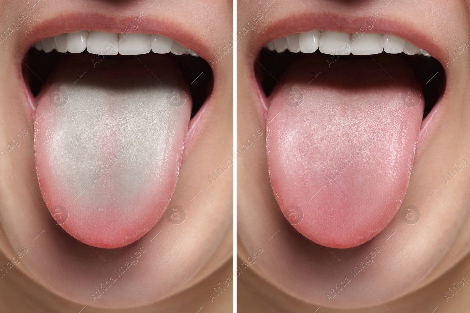 Image of Woman showing her tongue before and after cleaning procedure, closeup. Tongue coated with plaque on one side and healthy on other, collage