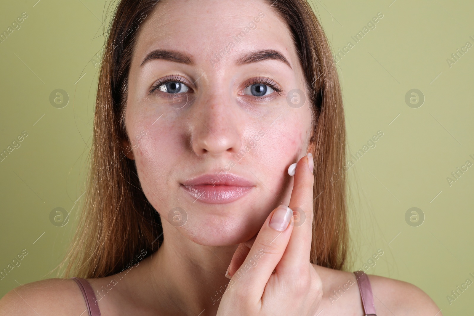 Photo of Young woman with acne problem applying cosmetic product onto her skin on olive background