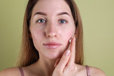 Young woman with acne problem applying cosmetic product onto her skin on olive background