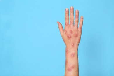 Woman with rash suffering from monkeypox virus on light blue background, closeup. Space for text