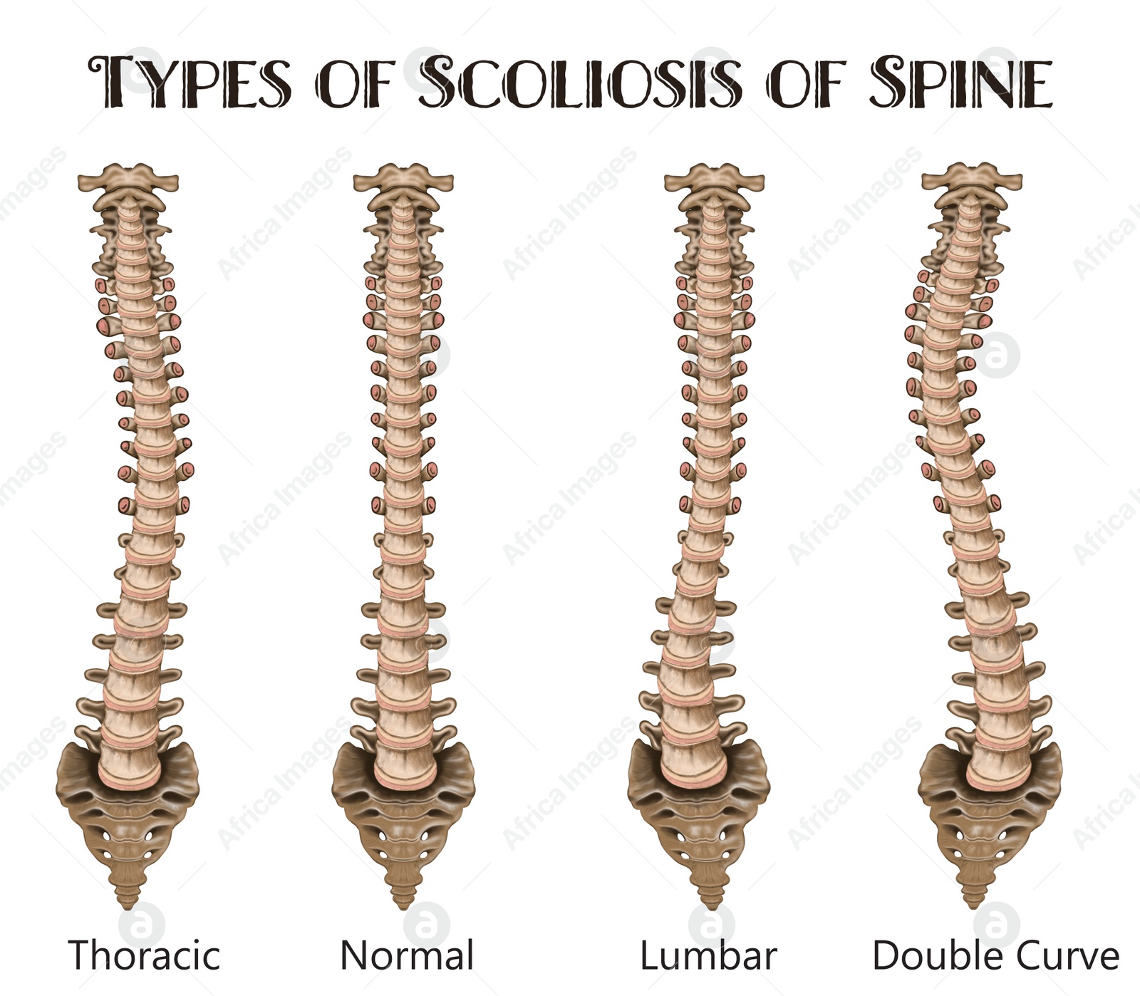 Illustration of Medical poster demonstrating types of scoliosis on white background.  healthy and diseased spine