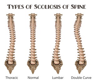 Illustration of Medical poster demonstrating types of scoliosis on white background.  healthy and diseased spine