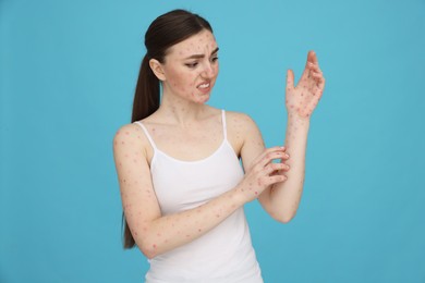 Woman with rash suffering from monkeypox virus on light blue background