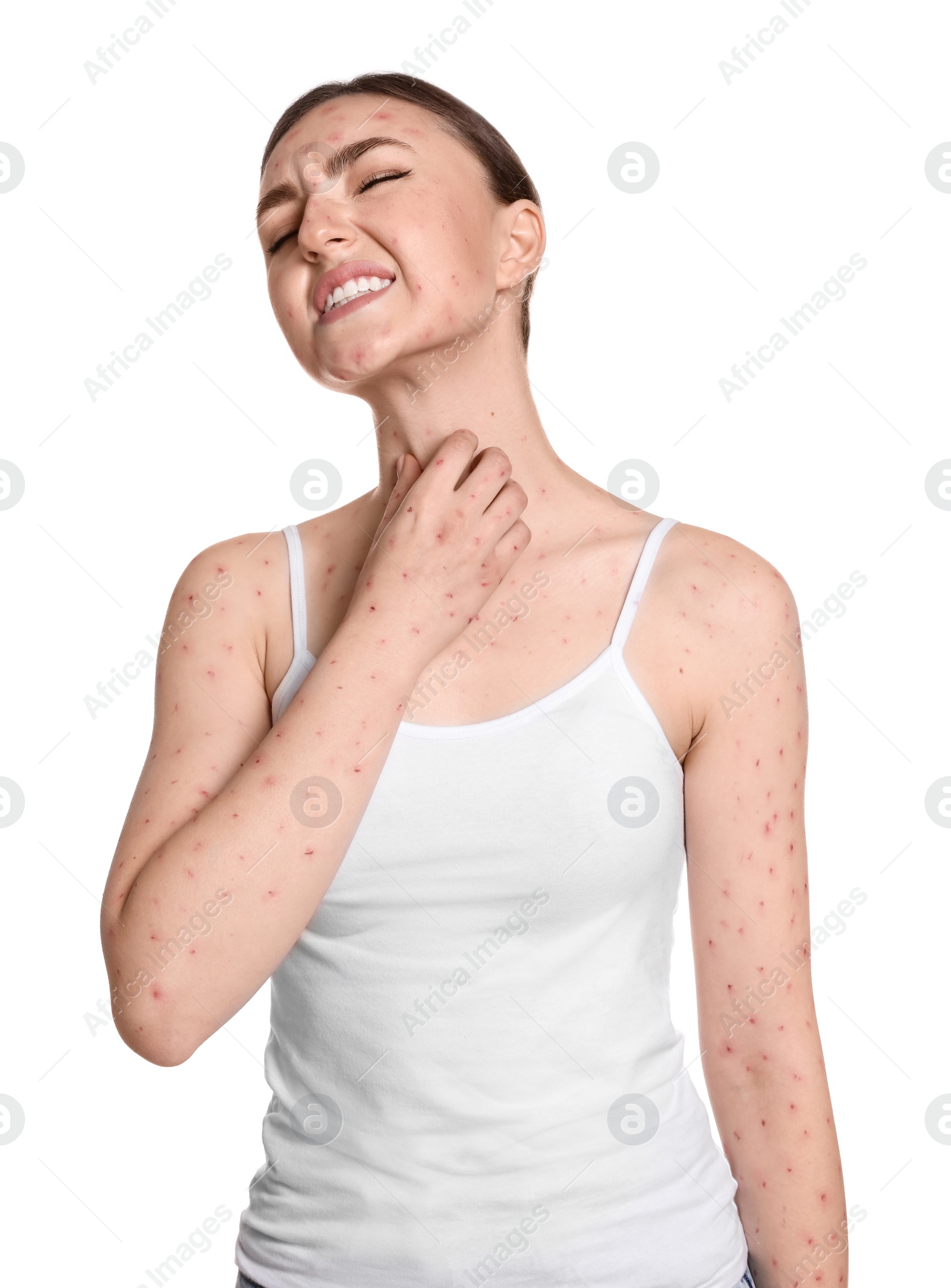 Photo of Woman with rash suffering from monkeypox virus on white background