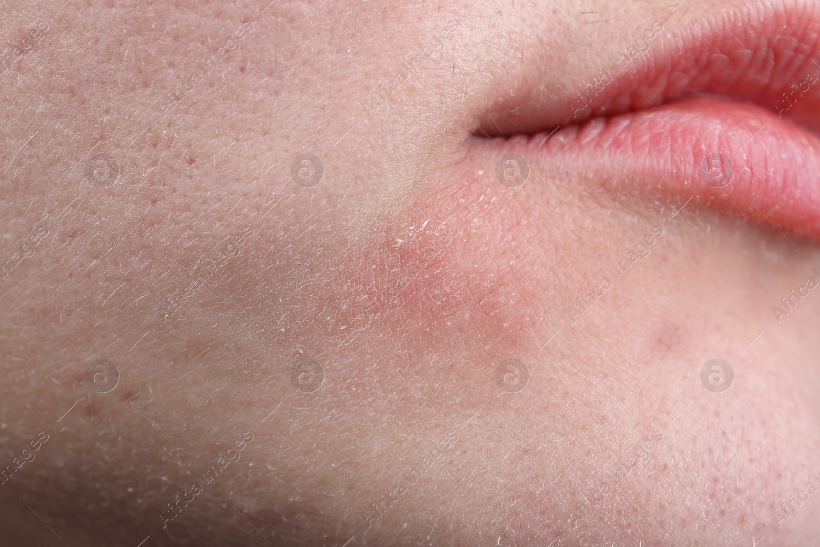 Photo of Woman with dry skin on face, closeup