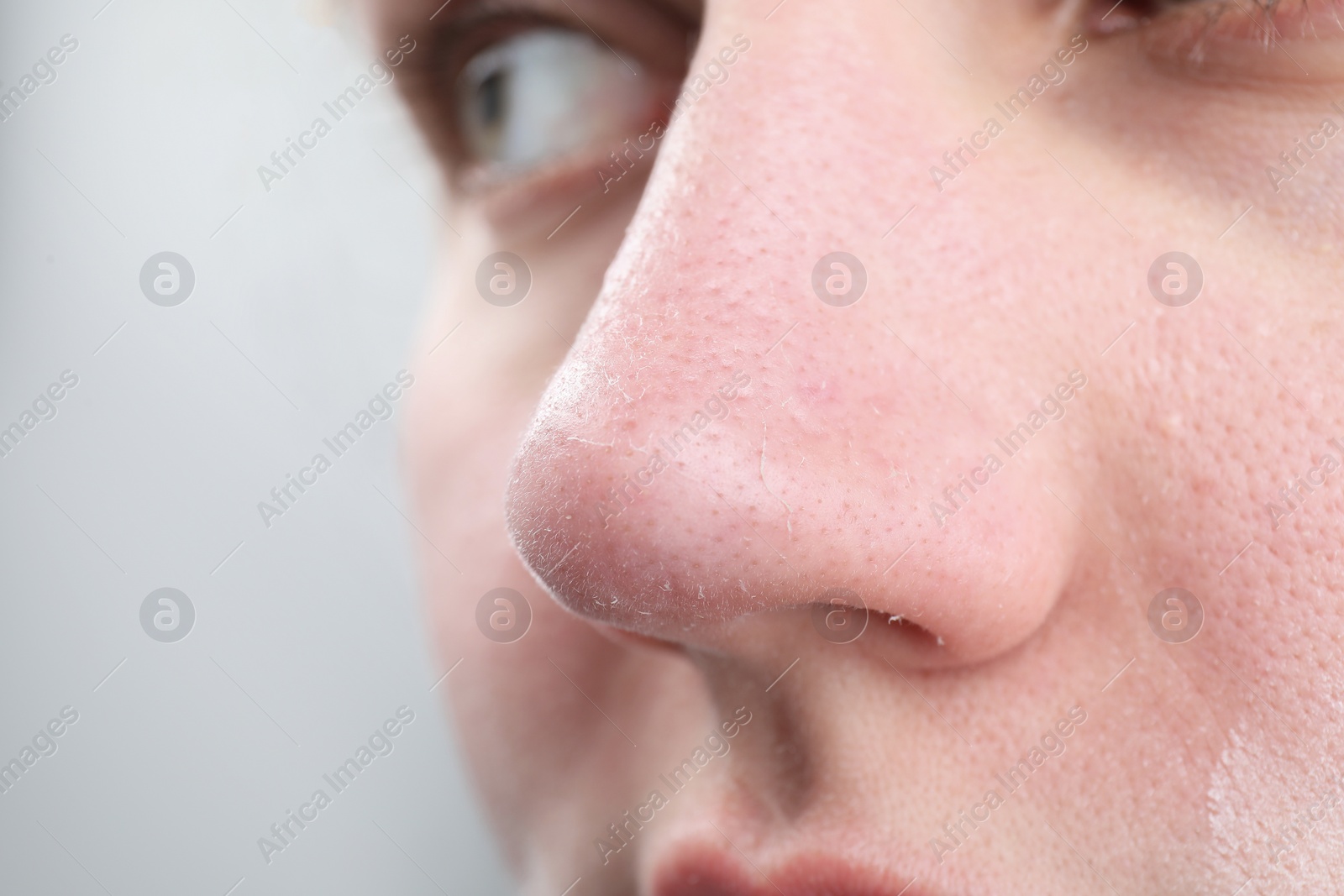 Photo of Woman with dry skin on nose against light background, closeup