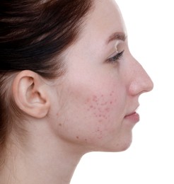 Photo of Young woman with acne problem on white background