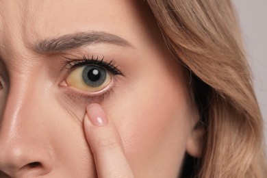 Photo of Woman with yellow eyes, closeup. Liver problems symptom