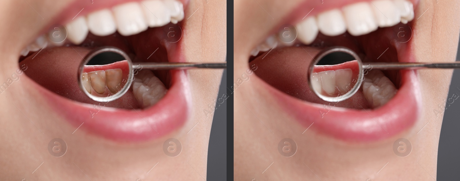 Image of Collage with photos of woman before and after professional treatment of dental plaque, closeup. Banner design