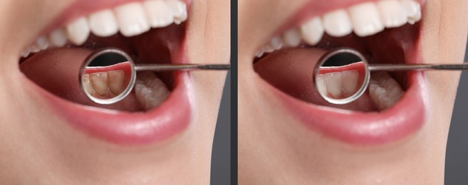 Collage with photos of woman before and after professional treatment of dental plaque, closeup. Banner design