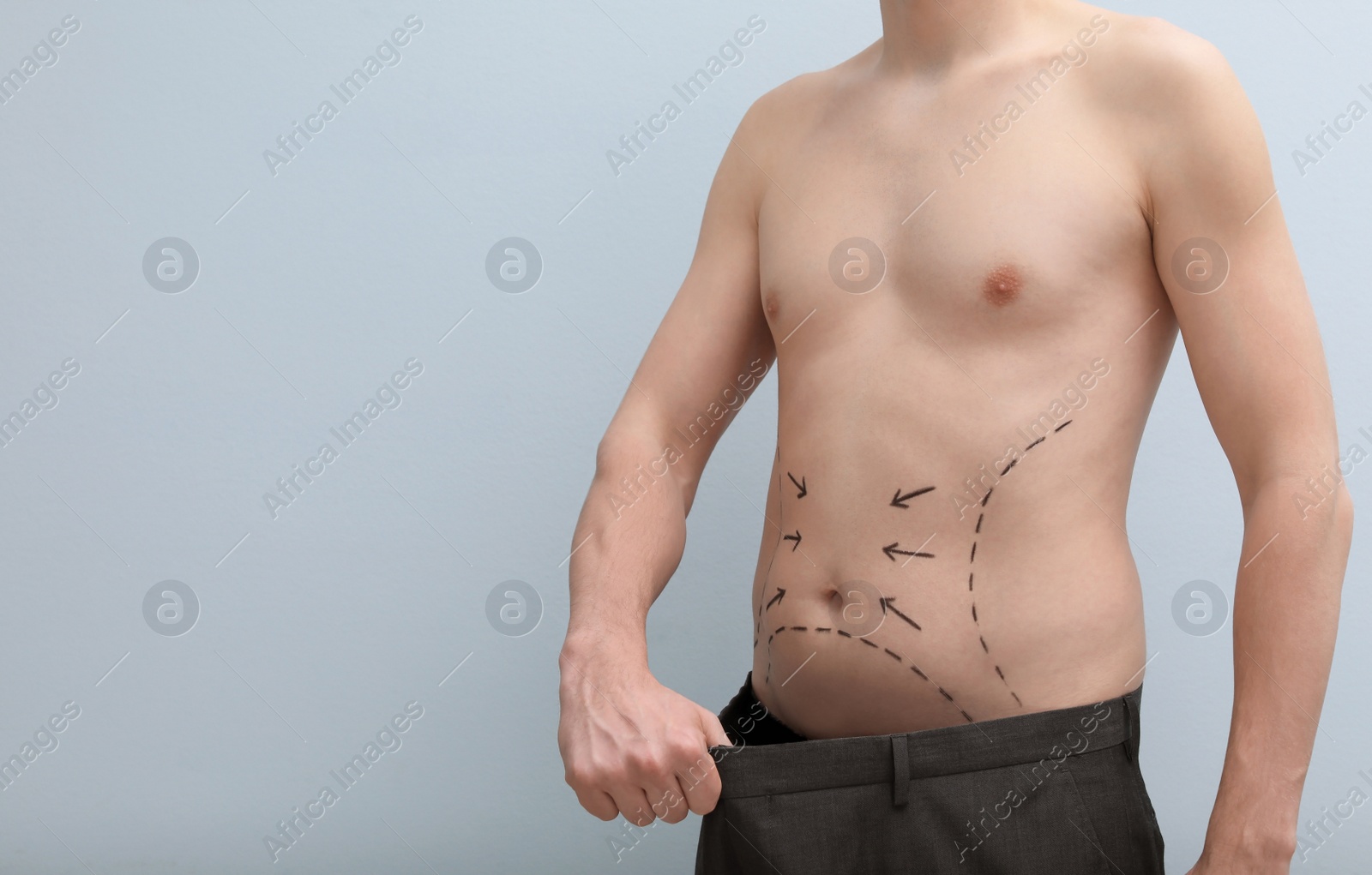 Photo of Young man with marks on belly for cosmetic surgery operation on light background