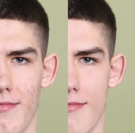 Acne problem. Young man before and after treatment on green background, collage of photos