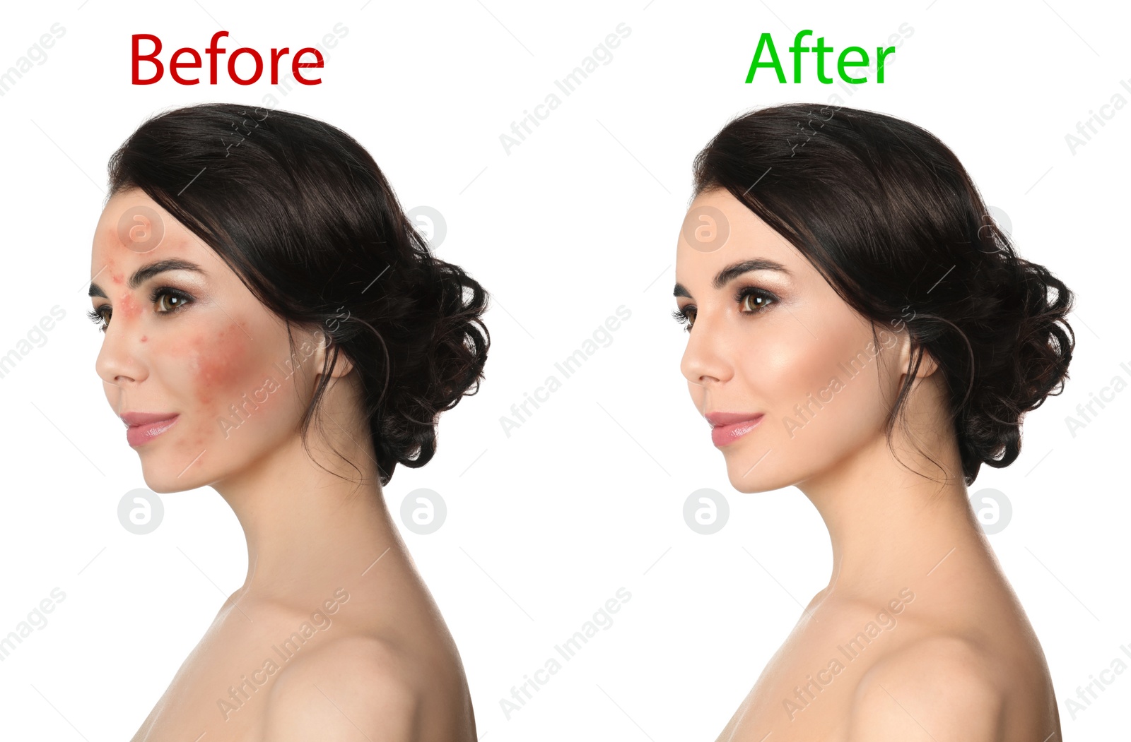 Image of Young woman before and after cosmetic procedure on white background