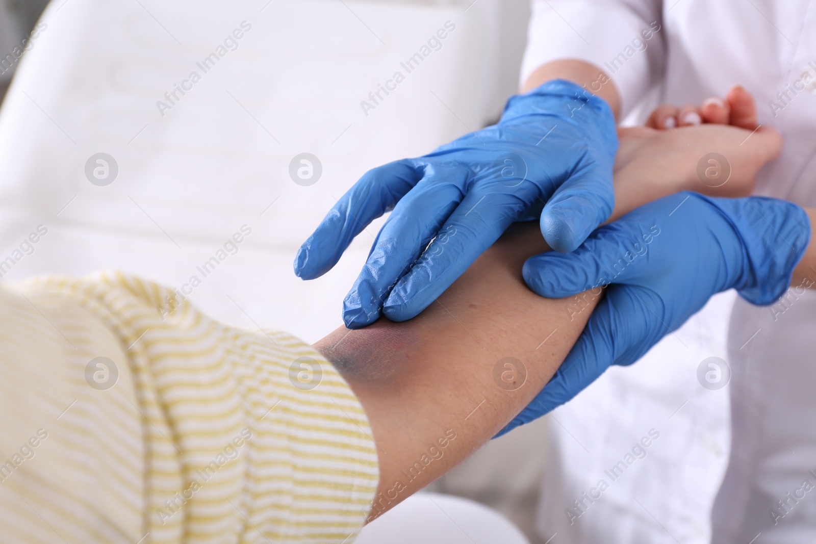 Photo of Doctor checking woman's elbow with bruise at hospital, closeup