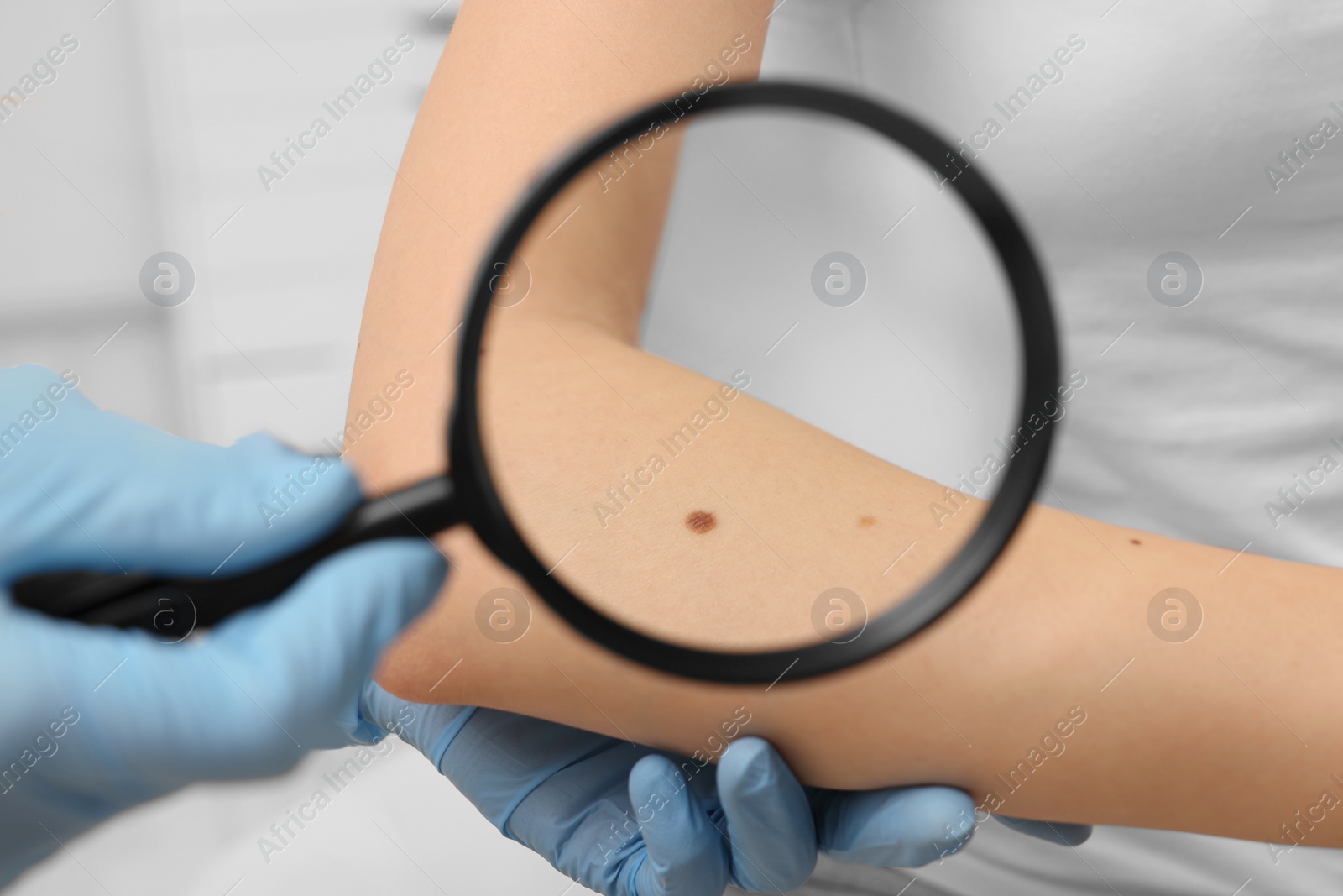 Photo of Dermatologist examining patient's birthmark with magnifying glass indoors, closeup