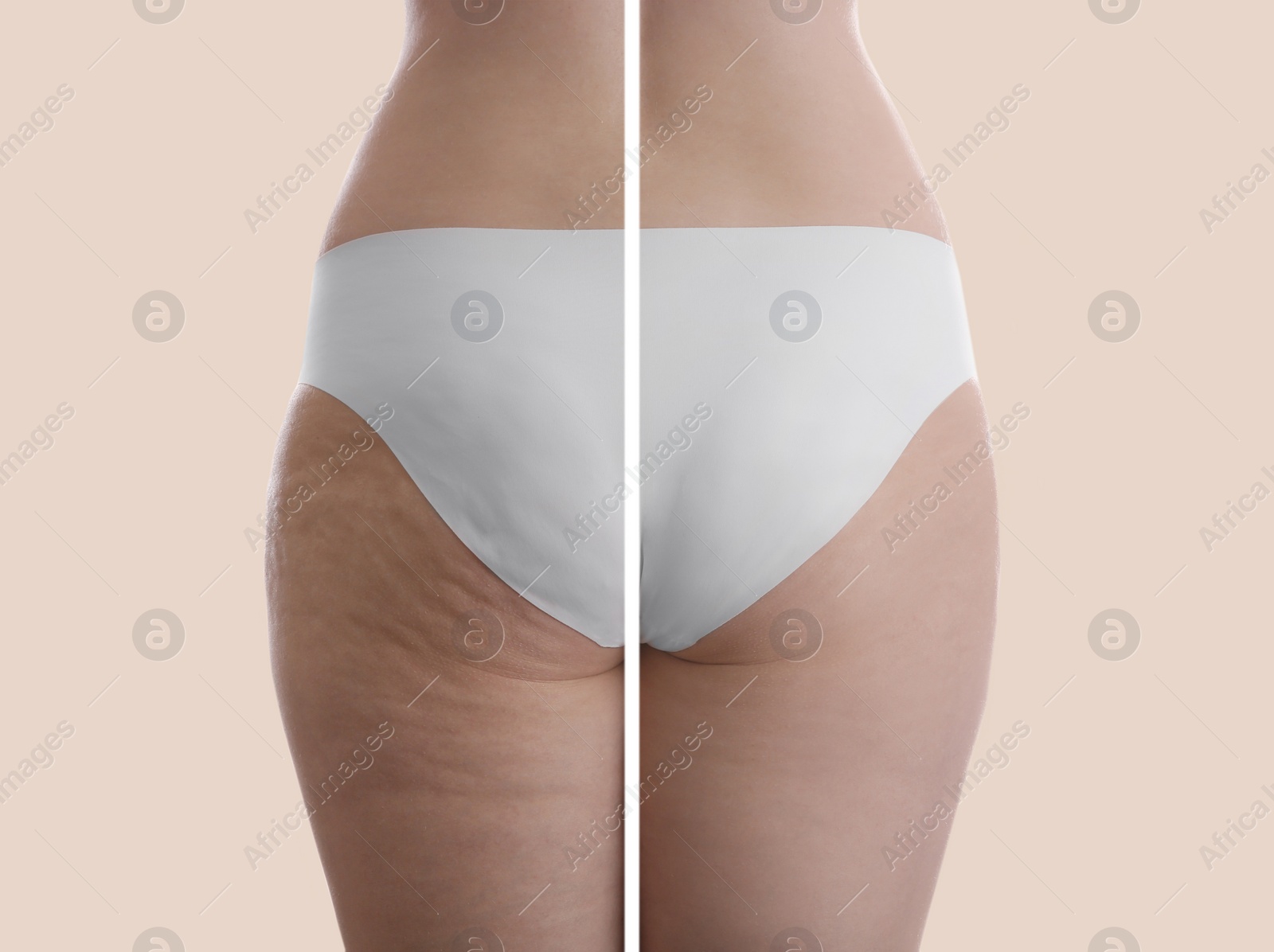 Image of Collage with photos of woman before and after anti cellulite treatment on beige background, 