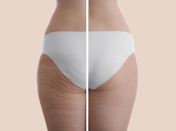 Image of Collage with photos of woman before and after anti cellulite treatment on beige background, 