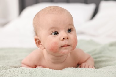 Photo of Cute little baby with allergic redness on cheeks lying on bed at home