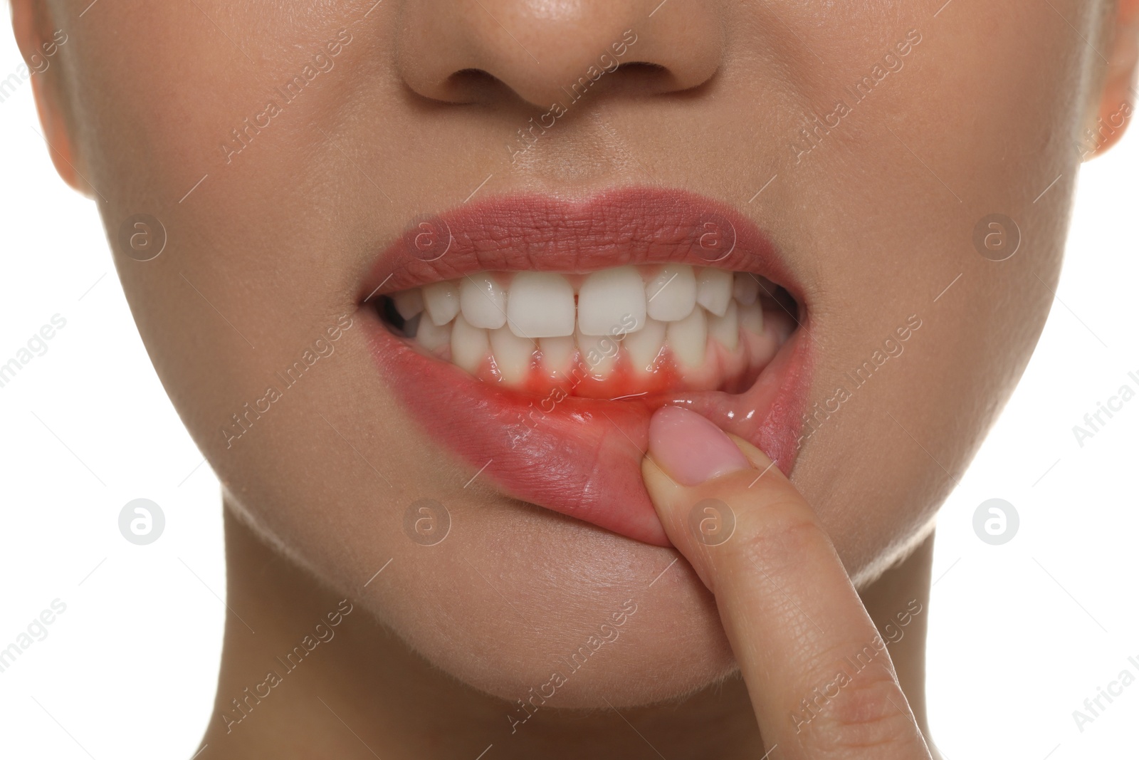 Image of Young woman showing inflamed gums, closeup view