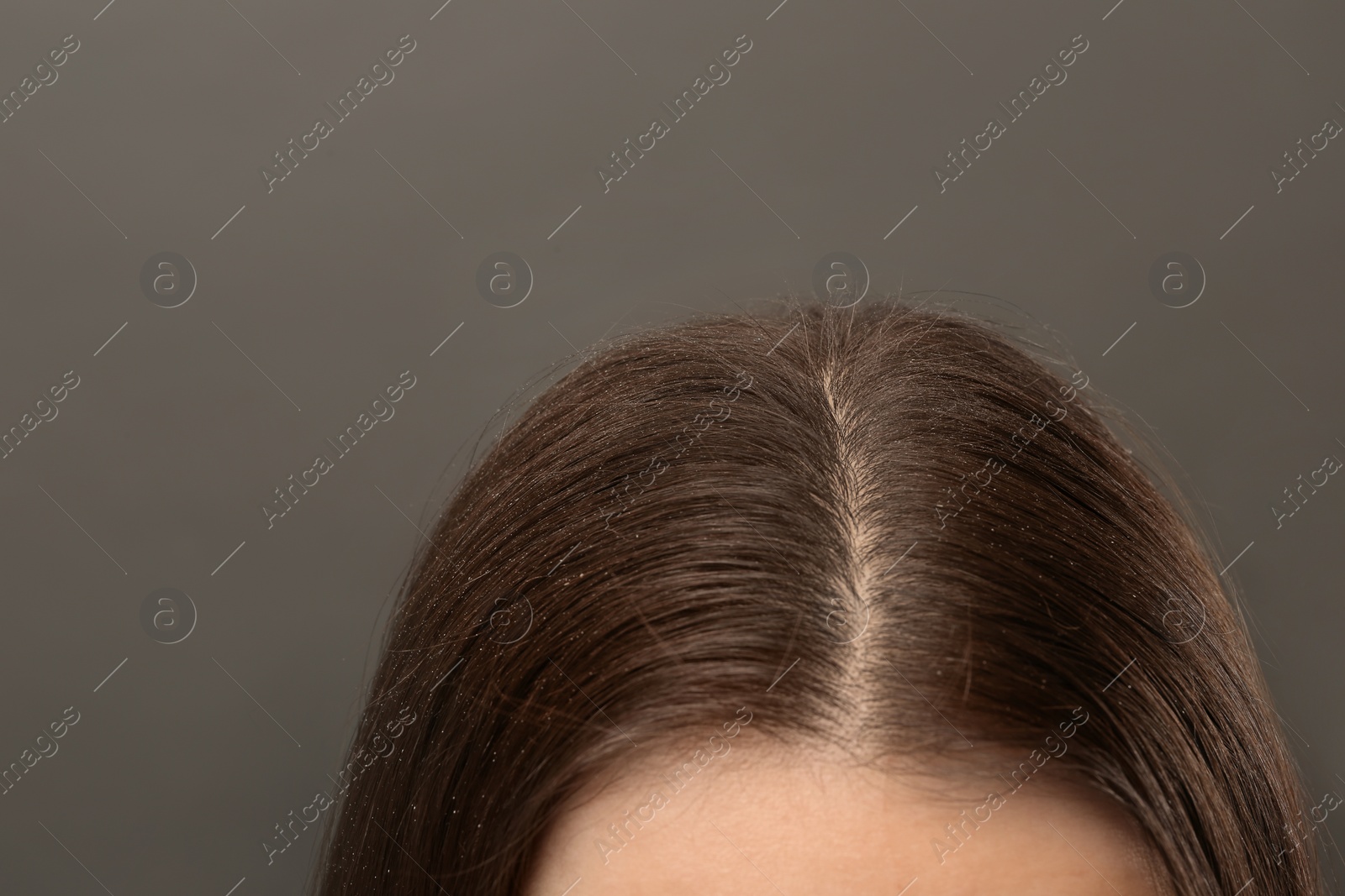 Photo of Woman with dandruff in her dark hair on grey background, closeup view. Space for text