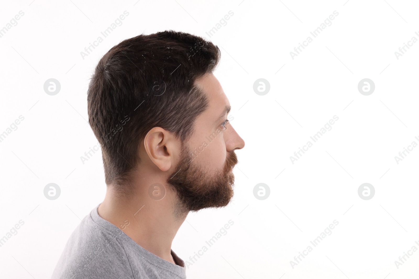 Photo of Man with dandruff in his dark hair on white background