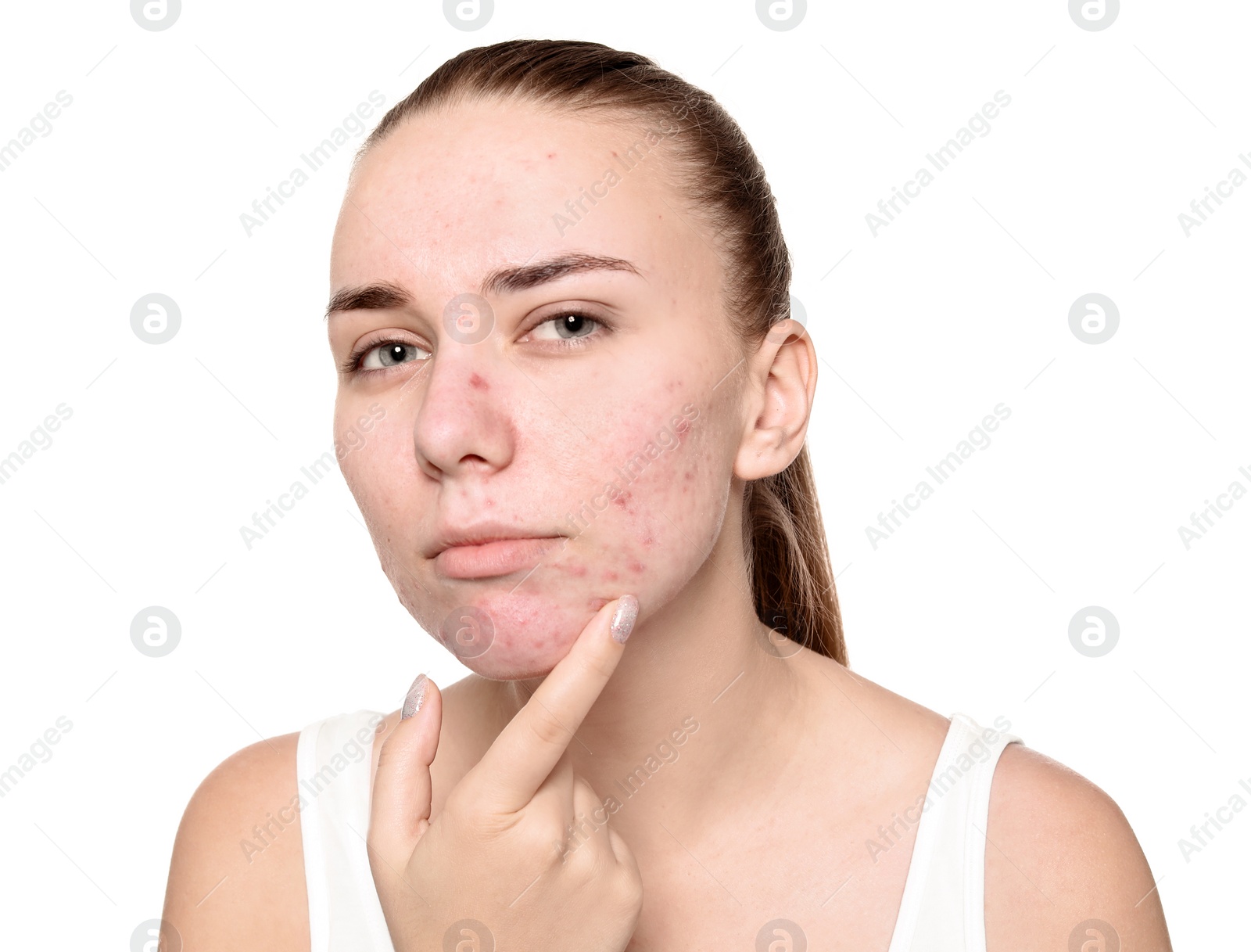 Photo of Young woman with acne problem on white background