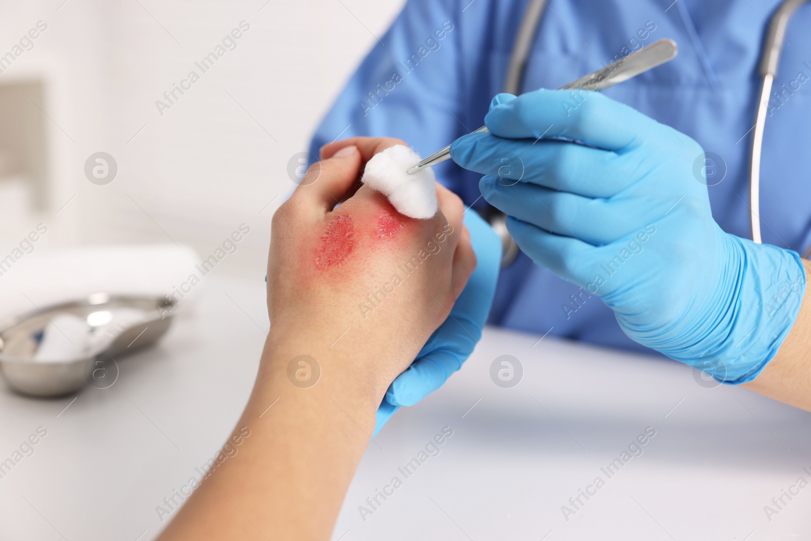 Photo of Doctor treating patient's burned hand at table, closeup