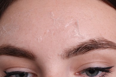 Photo of Woman with dry skin on forehead, macro view